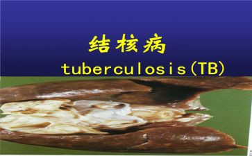结核病防治工作计划5篇