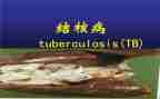 结核病防治工作计划5篇